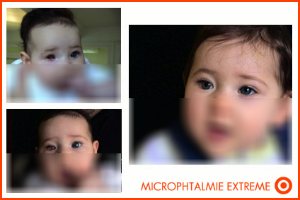 malformation-coulaire-microphtalmie-anophtalmie
