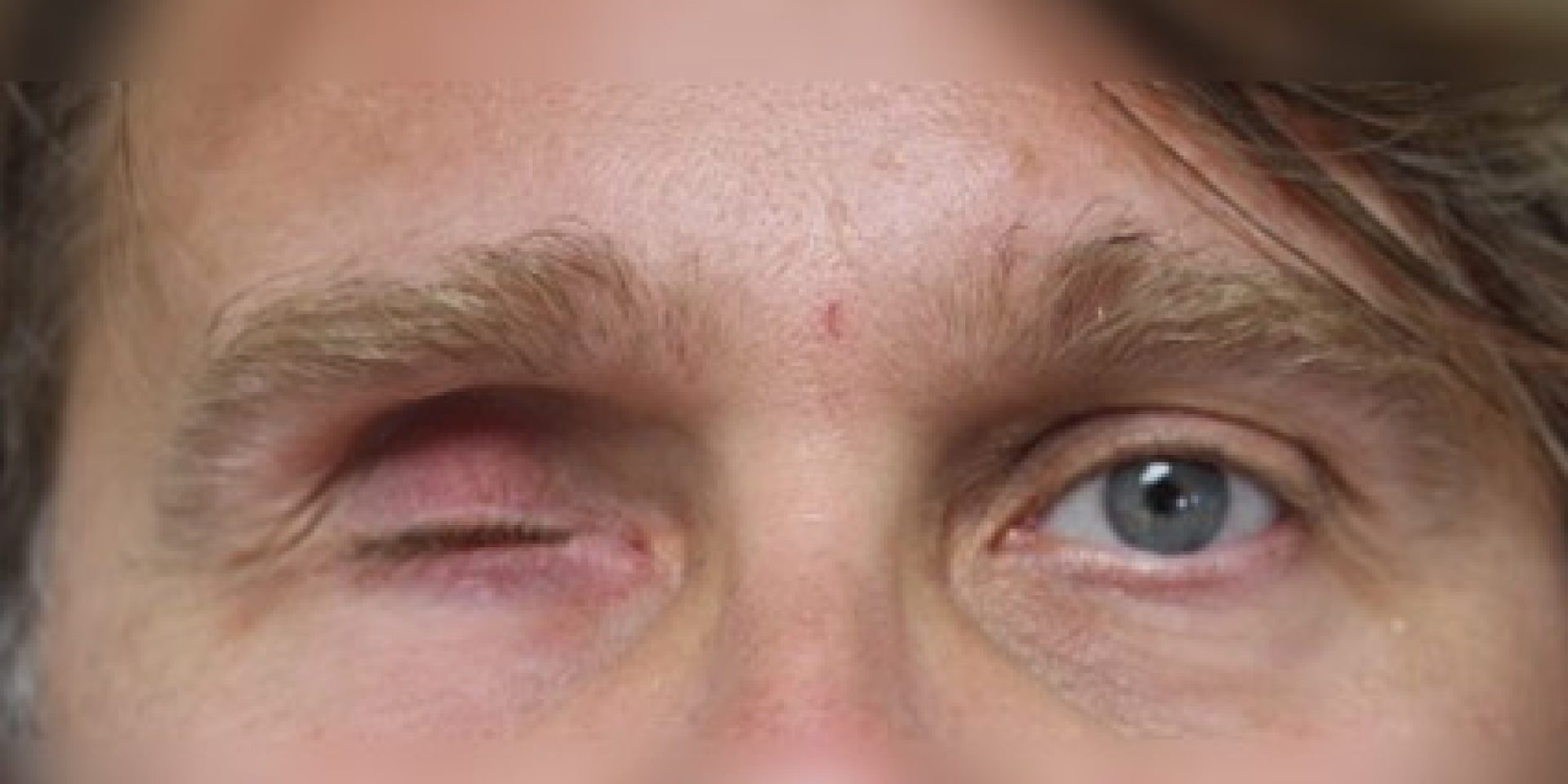 Enucléation oculaire Oculariste suisse