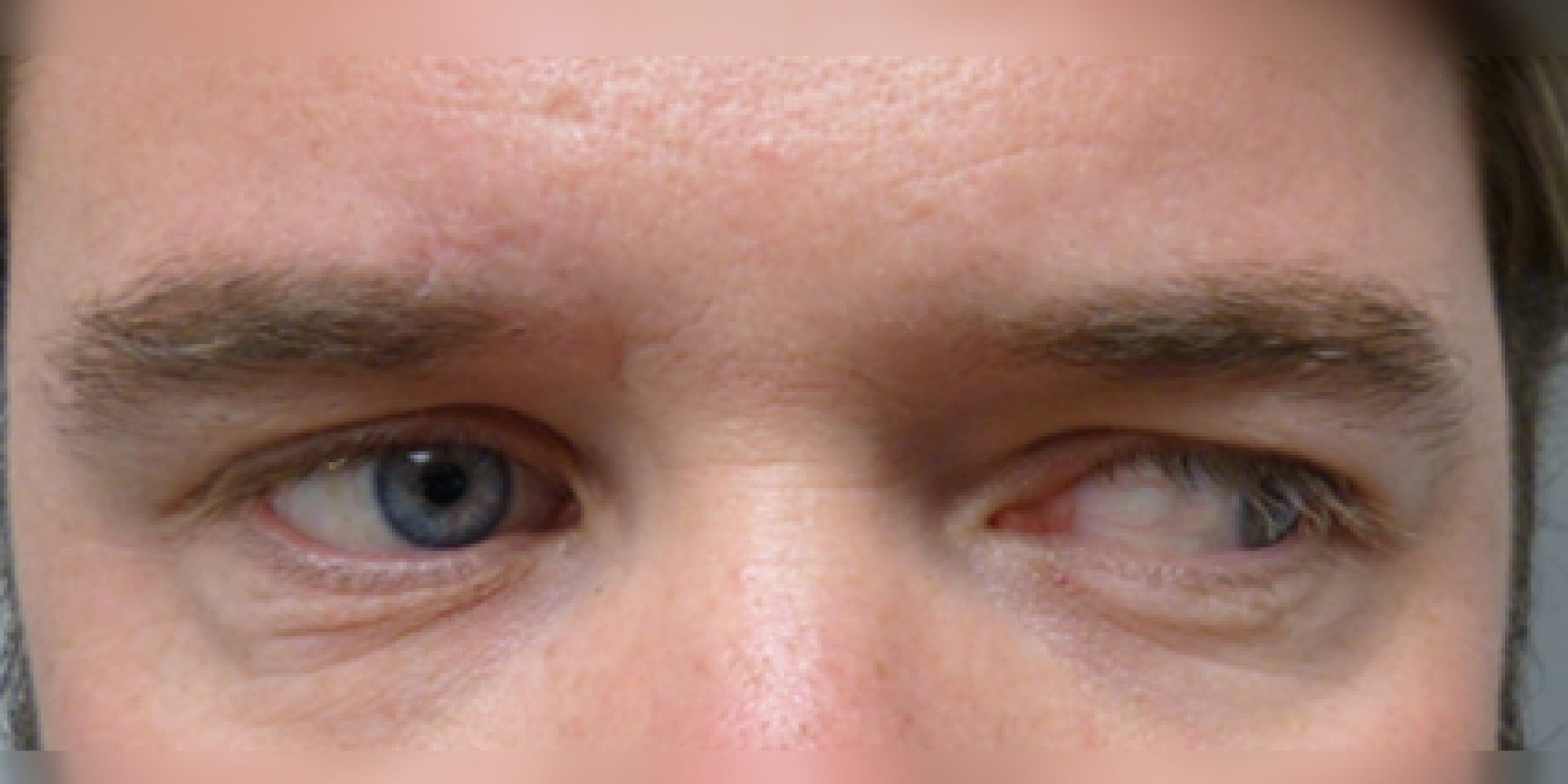 Scleral shell - DCM Ocularist Geneva