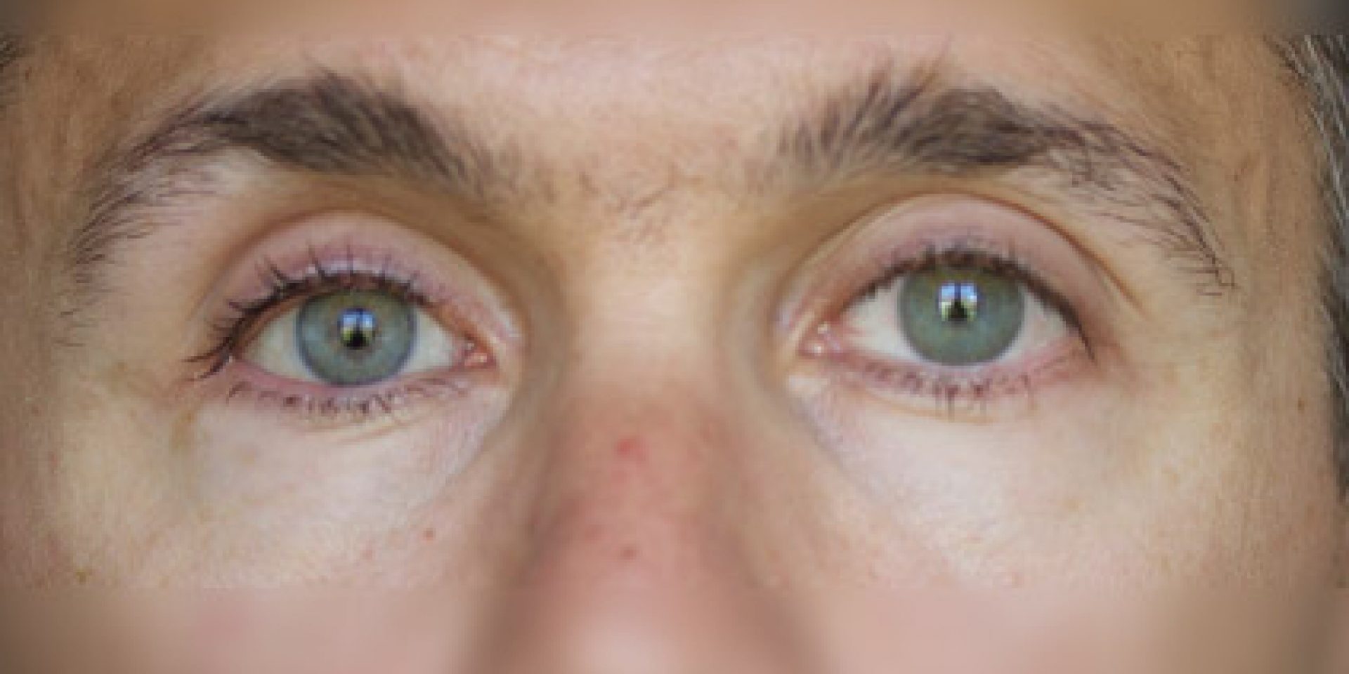 Eviscerazione Dell Occhio Dcm Oculariste Svizzero