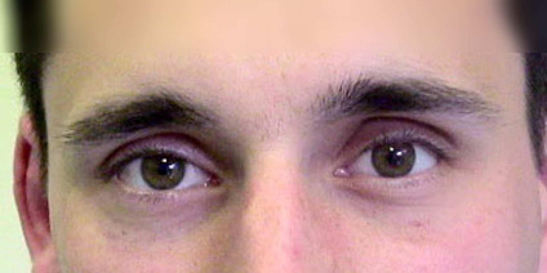 Eviscerazione Dell Occhio Dcm Oculariste Svizzero